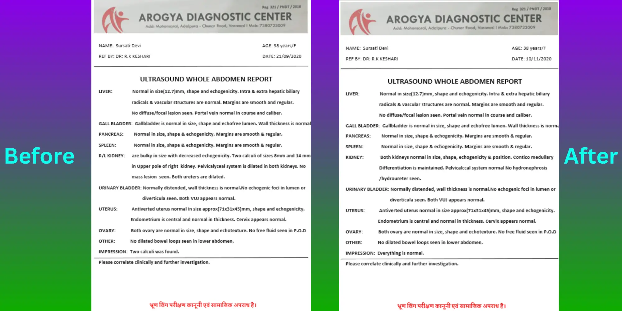 Gallstone Patient Sursati Devi - Before After Treatment