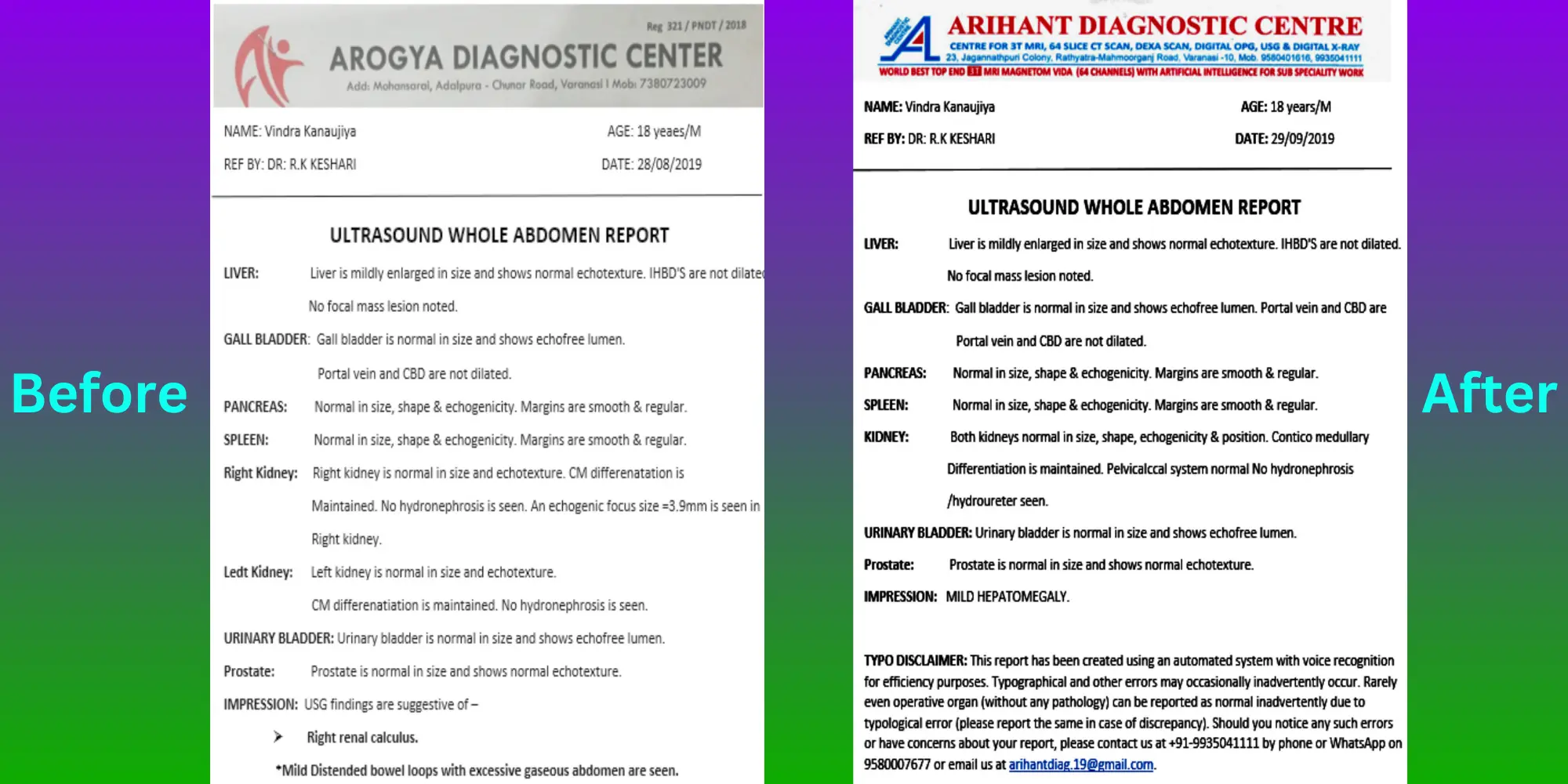 Gallstone Patient Vindra Kanaujiya - Before After Treatment